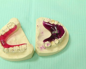 Czy to działa? Co trzeba wiedzieć o aparatach zdejmowanych