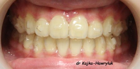 Czas leczenia - 4 m-ce